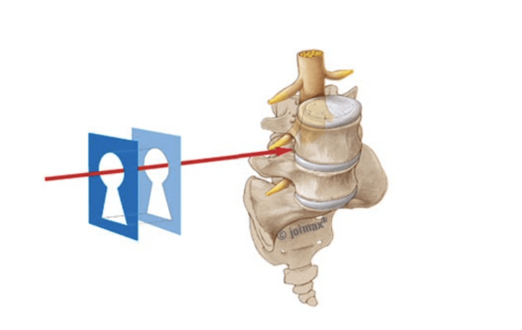 Spinal Stenosis 3