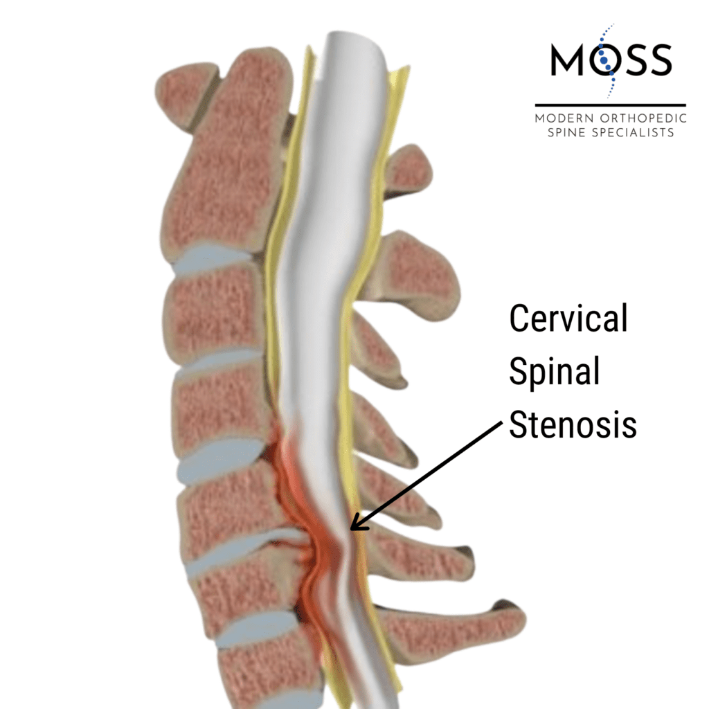 cervical stenosis