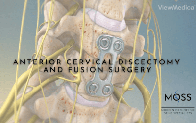 Anterior Cervical Discectomy & Fusion Surgery (ACDF)
