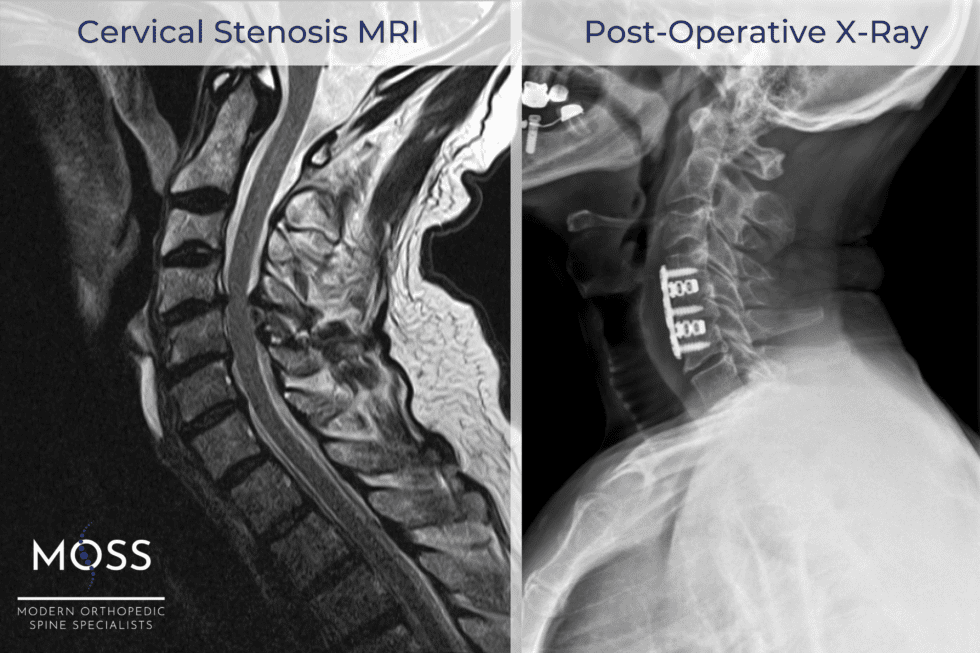 CERVICAL STENOSIS WITH MYELOPATHY Modern Orthopedic Spine Specialists